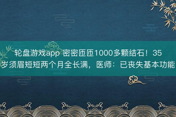 轮盘游戏app 密密匝匝1000多颗结石！35岁须眉短短两个月全长满，医师：已丧失基本功能